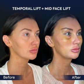 before-after photo lipomodelirovanie-lica