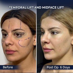 before-after photo lipomodelirovanie-lica