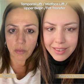 before-after photo lipomodelirovanie-lica