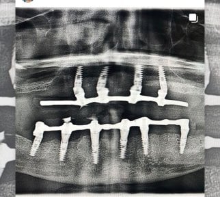 نتيجة أشعة سينية لزرعات All-on-4 في عيادة Shtern Dental مع تثبيت آمن