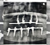 نتيجة أشعة سينية لزرعات All-on-4 في عيادة Shtern Dental مع تثبيت آمن