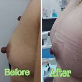 before-after photo nipple-reduction