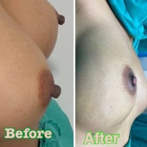 before-after photo nipple-reduction
