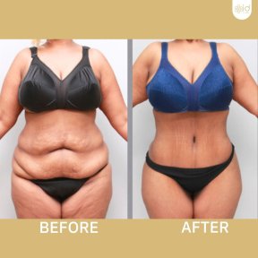 before-after photo abdominoplasty