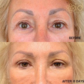 before-after photo upper-eyelid-surgery