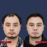 نتيجة زراعة الشعر قبل وبعد في ID Clinic Bangkok، خط شعر أكثر كثافة بعد 8 أشهر