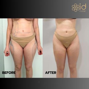 before-after photo vaser-liposuction