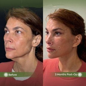 before-after photo glubokaya-podtyazhka-lica-deep-plane-facelift