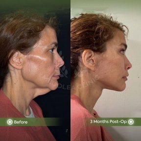 before-after photo glubokaya-podtyazhka-lica-deep-plane-facelift