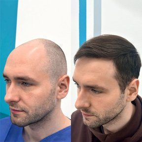 before-after photo hair-transplant