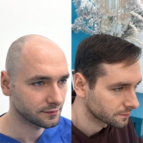 before-after photo hair-transplant