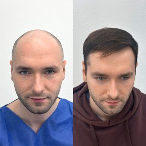 before-after photo hair-transplant