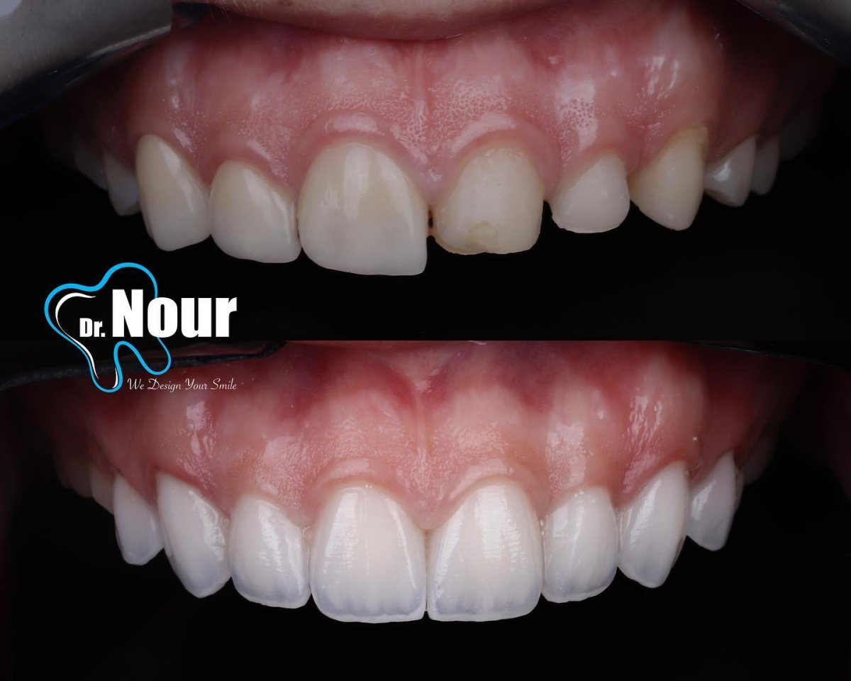 نتيجة قبل وبعد فينير الزركونيا في عيادة Dr. Nour – تحسين جمالية الابتسامة