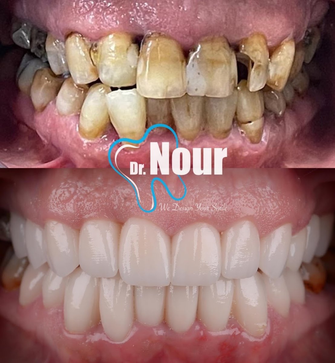 نتائج قبل وبعد ابتسامة هوليوود في عيادة د. نور – ترميم كامل للأسنان