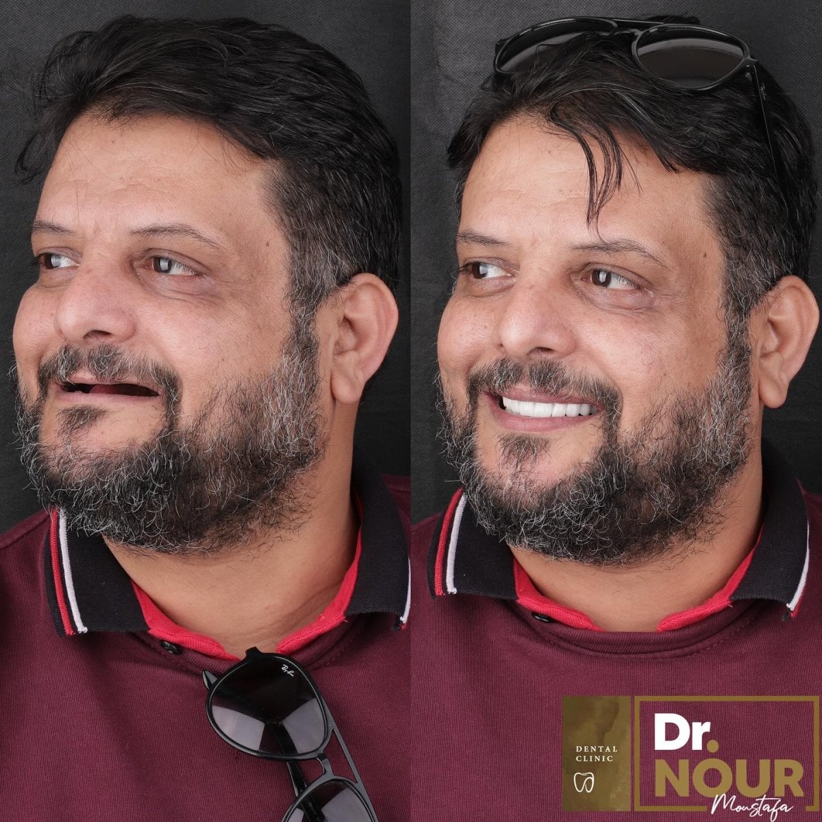 Resultados de implantes dentales antes y después en Dr. Nour Mostafa Dental Clinic, sonrisa restaurada