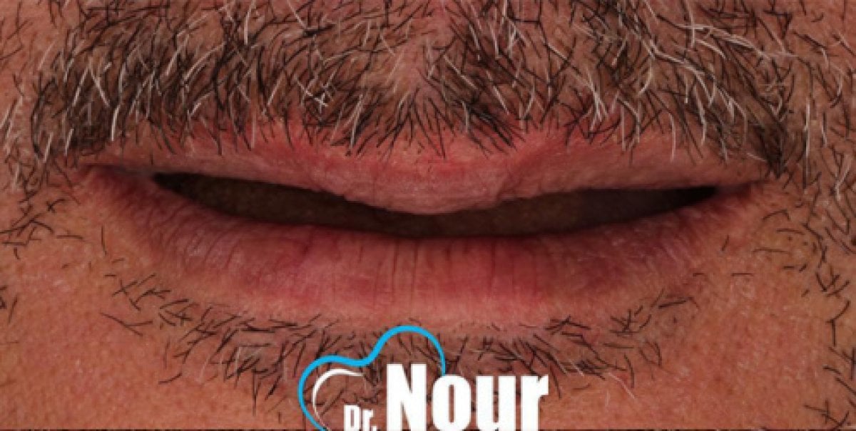 Antes de la instalación de dentadura completa en la clínica Dr. Nour – falta de dientes superiores