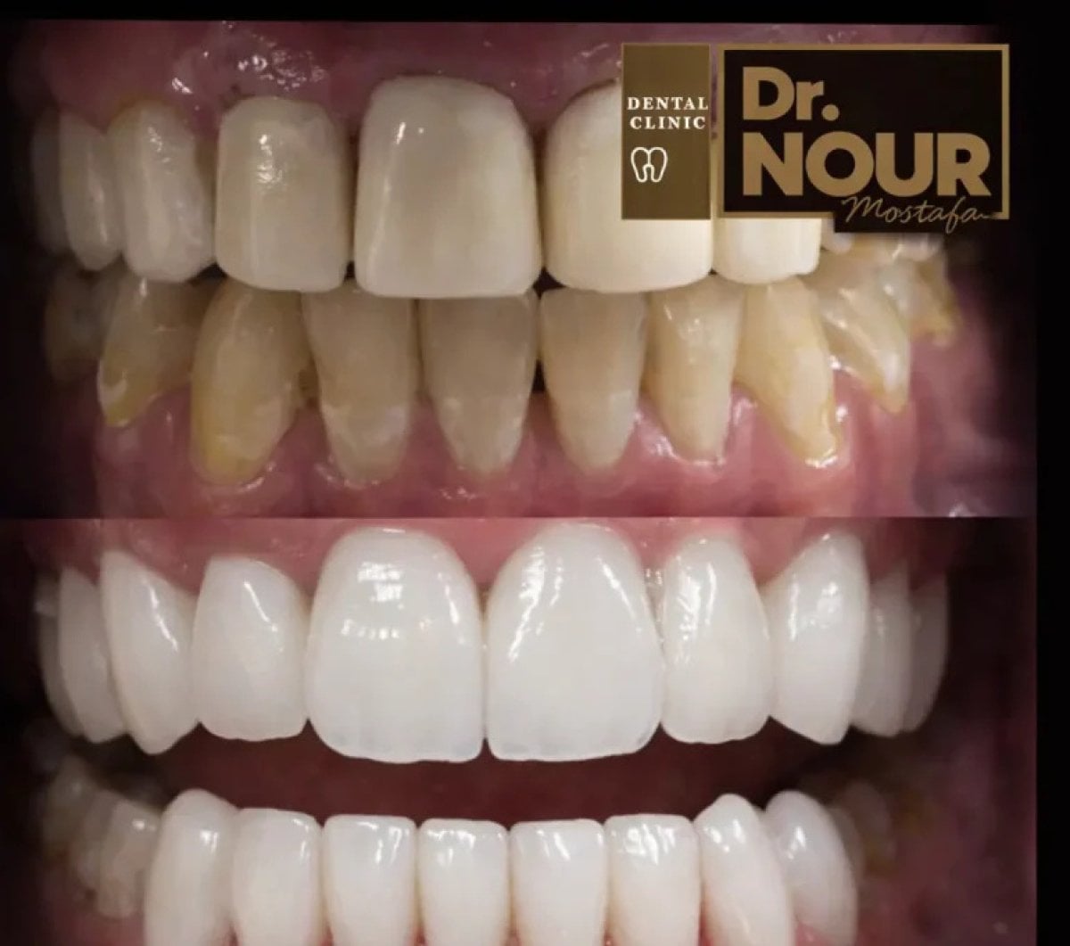 Resultados de blanqueamiento dental antes y después en Dr. Nour Dental Clinic – sonrisa brillante