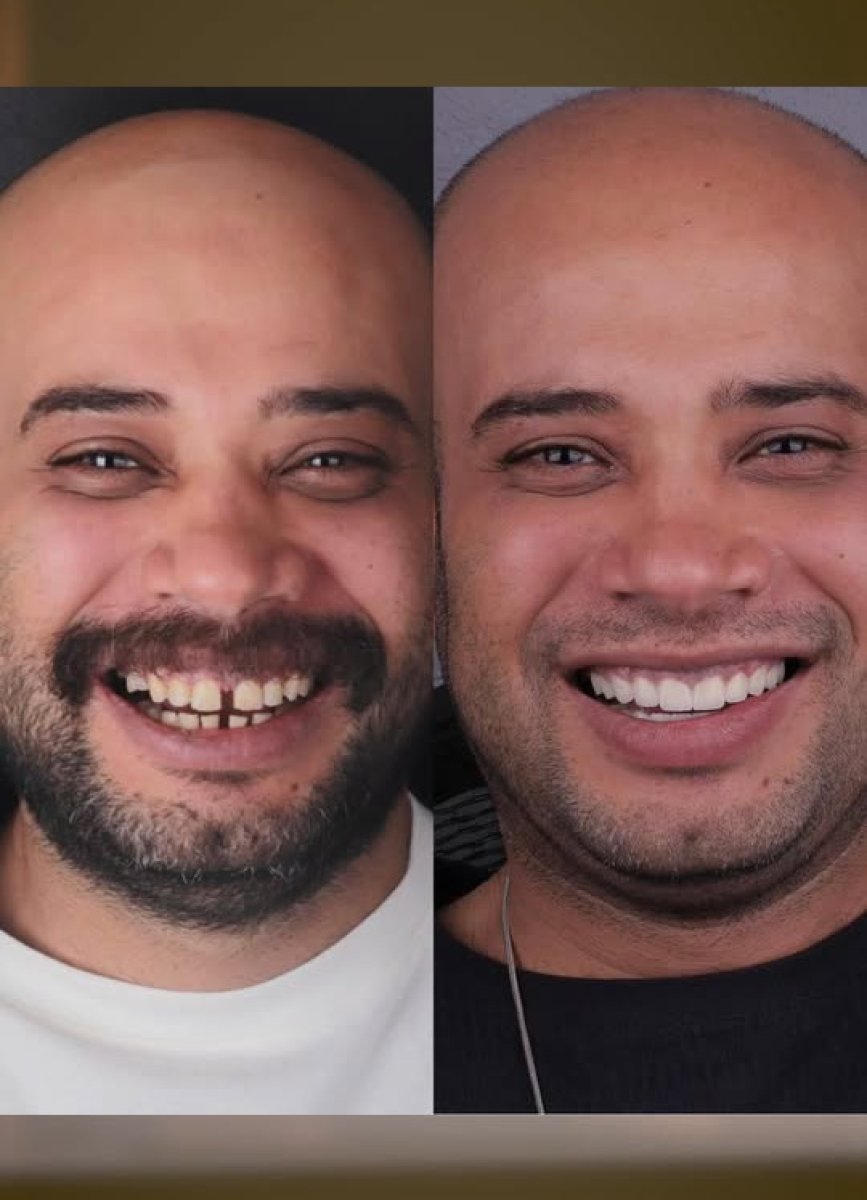Resultados antes y después de smile makeover: dientes alineados y sonrisa más blanca