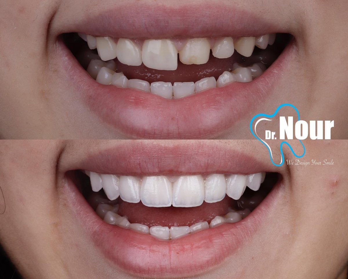 نتائج قبل وبعد تجميل الابتسامة في عيادة Dr. Nour – تحول القشور الخزفية