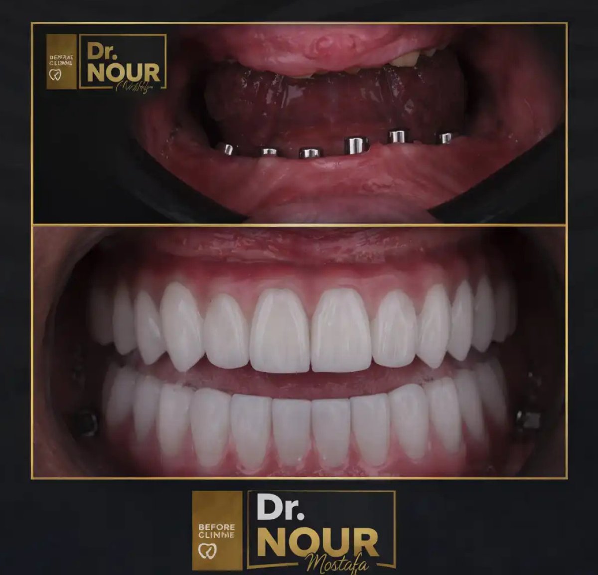 نتيجة قبل وبعد طقم أسنان زركونيا كامل على 6 غرسات تيتانيوم لدى Dr. Nour