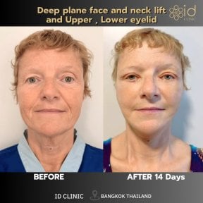 before-after photo deep-plane-facelift