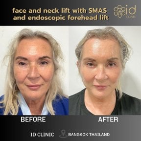before-after photo tightening-of-facial-skin-facelift