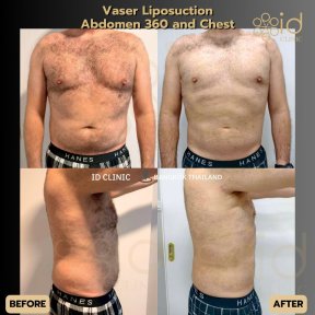 before-after photo liposuction