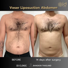 before-after photo liposuction
