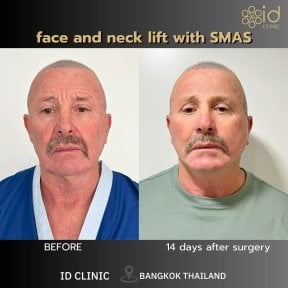 before-after photo tightening-of-facial-skin-facelift