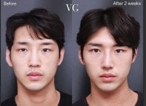 Blepharoplasty before and after results at VG Plastic Surgery – eyelid correction after 2 weeks