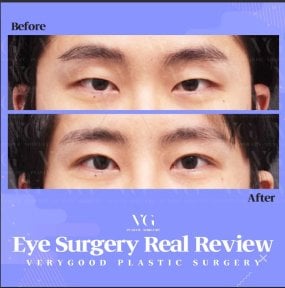 Blepharoplasty before and after results at VG Plastic Surgery – eyelid correction improvement