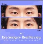 Blepharoplasty before and after results at VG Plastic Surgery – eyelid correction improvement