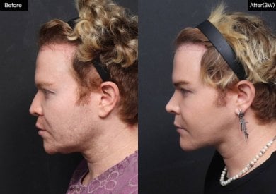 Before and after jawline contouring at VG Plastic Surgery, visible chin and jaw enhancement result