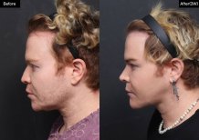 Before and after jawline contouring at VG Plastic Surgery, visible chin and jaw enhancement result