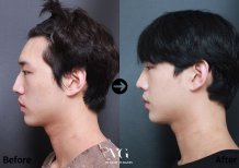 Before and after rhinoplasty result at VG Plastic Surgery, improved nose profile and contour