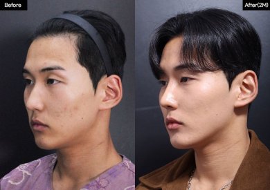 Before and after rhinoplasty results at VG Plastic Surgery – improved nose shape and profile