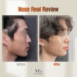 Before and after rhinoplasty results at VG Plastic Surgery, improved nose shape and profile