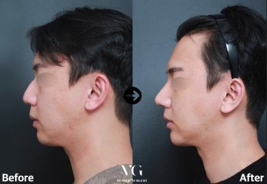 Before and after blepharoplasty results at VG Plastic Surgery, eyelid correction in male patient