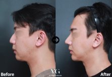 Before and after blepharoplasty results at VG Plastic Surgery, eyelid correction in male patient