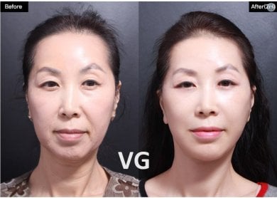 Before and after deep plane facelift results at VG Plastic Surgery, facial rejuvenation visible