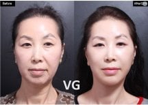 Before and after deep plane facelift results at VG Plastic Surgery, facial rejuvenation visible