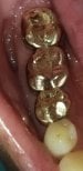 Resultado de implante dental con coronas de oro en SoftDentalCare Clinic, función molar restaurada