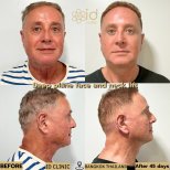Результаты до и после глубокого SMAS-лифтинга лица и шеи в ID Clinic Bangkok, 45 дней