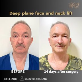 Результаты до и после глубокого лифтинга лица и шеи в ID Clinic Bangkok, видимое омоложение