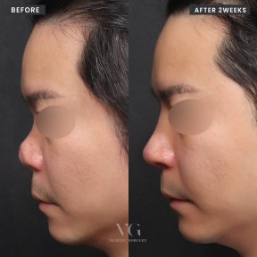 Résultats avant et après rhinoplastie secondaire chez VG Plastic Surgery, profil du nez amélioré
