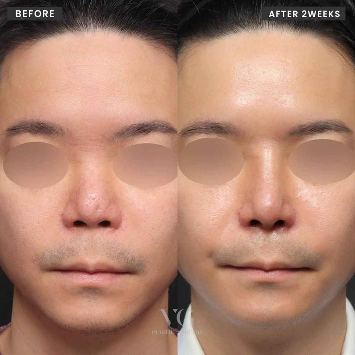 نتائج قبل وبعد عملية تجميل الأنف التصحيحية في VG Plastic Surgery، تحسين شكل الأنف