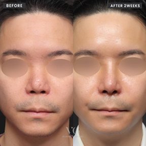 Résultats avant et après rhinoplastie secondaire chez VG Plastic Surgery, forme du nez améliorée