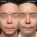 Résultats avant et après rhinoplastie secondaire chez VG Plastic Surgery, forme du nez améliorée