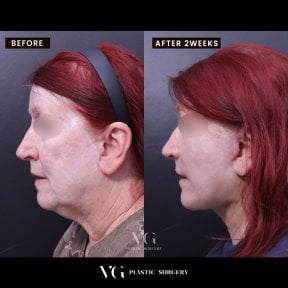 Facial feminization surgery before and after results at VG Plastic Surgery, 2 weeks post-op