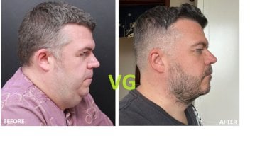 Before and after double chin liposuction at VG Plastic Surgery, visible jawline contour result
